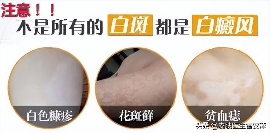 白斑病症解析，L80x00白斑能否自行消退？自然消退可能性探讨